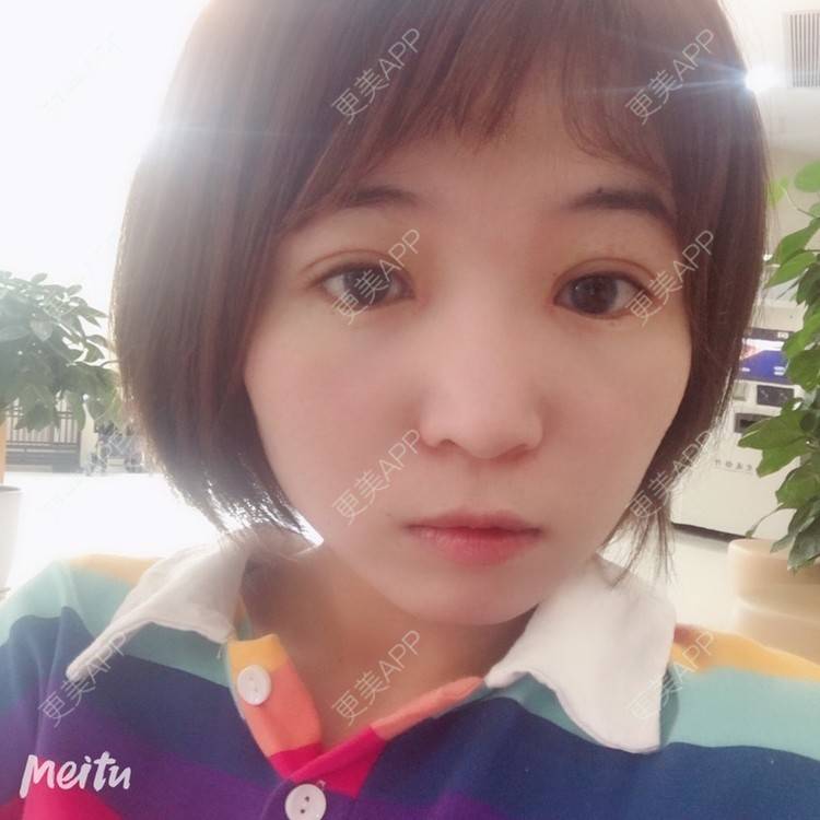 更美 - 更美用户6d6gGsAMox的双眼皮经验 | 双眼皮 | 石家庄