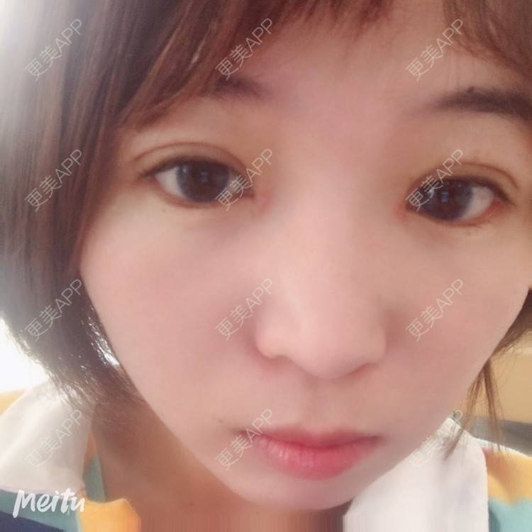 更美 - 更美用户6d6gGsAMox的双眼皮经验 | 双眼皮 | 石家庄