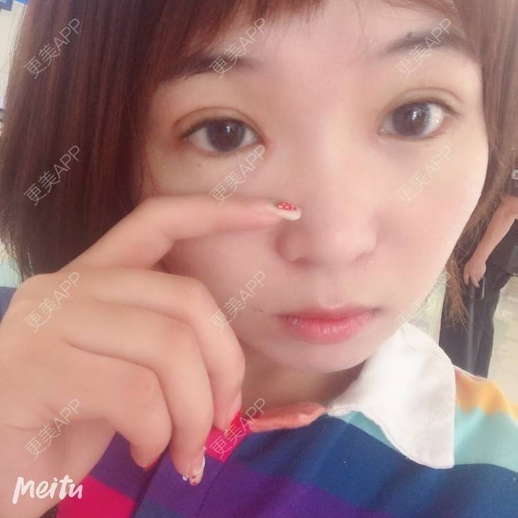 更美 - 更美用户6d6gGsAMox的双眼皮经验 | 双眼皮 | 石家庄