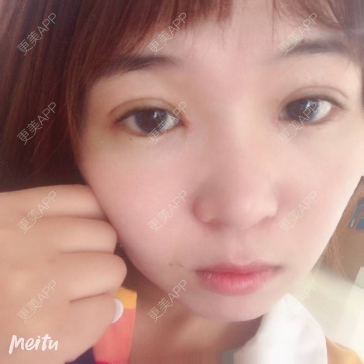 更美 - 更美用户6d6gGsAMox的双眼皮经验 | 双眼皮 | 石家庄