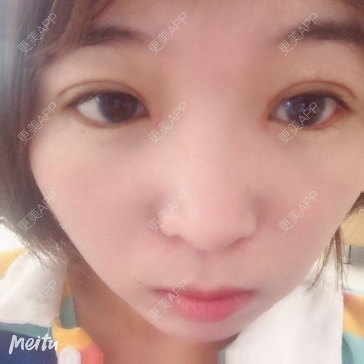 更美 - 更美用户6d6gGsAMox的双眼皮经验 | 双眼皮 | 石家庄