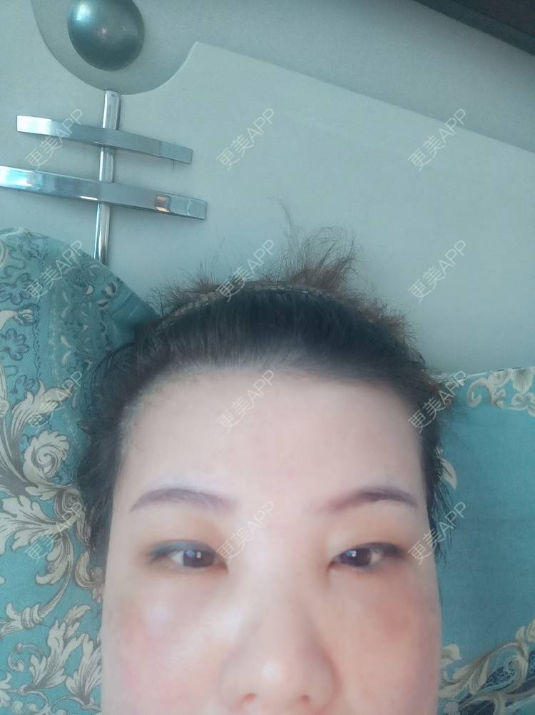 更美 - 星星闪闪的双眼皮经验 | 双眼皮 | 内切去眼袋 | 除皱瘦脸 | 武汉