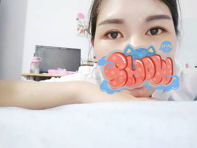 更美 - 杨丽 医生的双眼皮经验 | 双眼皮