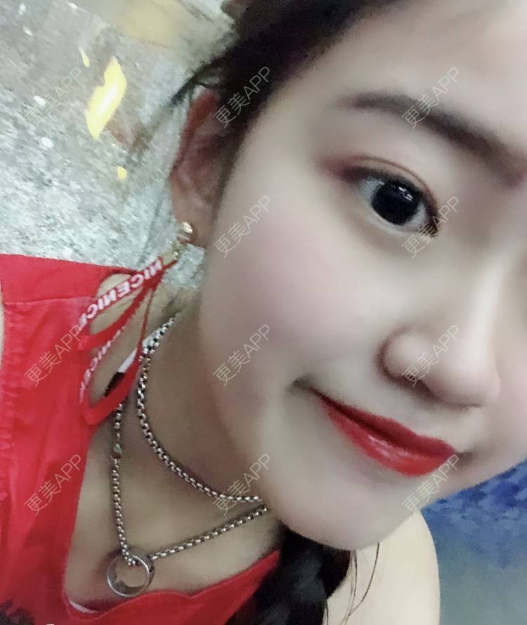 更美 - 小禅子的经验 | 成都 | 视频日记 | 激光淡疤 | 手术淡疤
