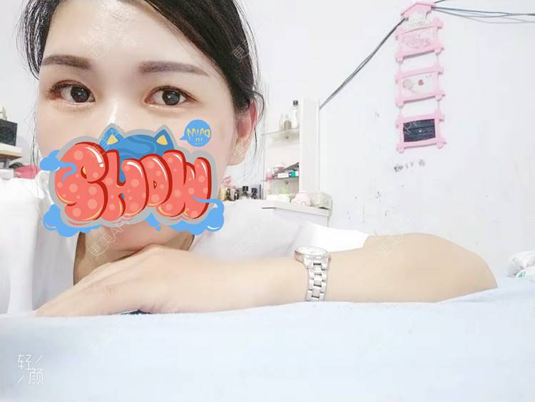 更美 - 杨丽 医生的双眼皮经验 | 双眼皮