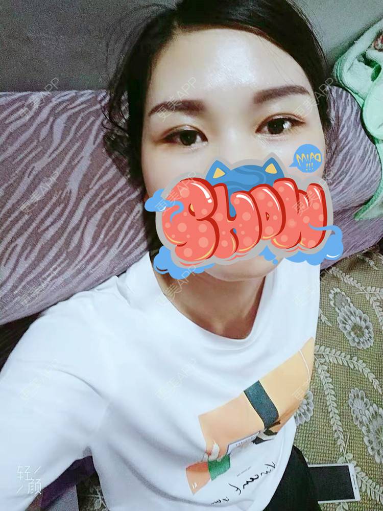 更美 - 杨丽 医生的双眼皮经验 | 双眼皮