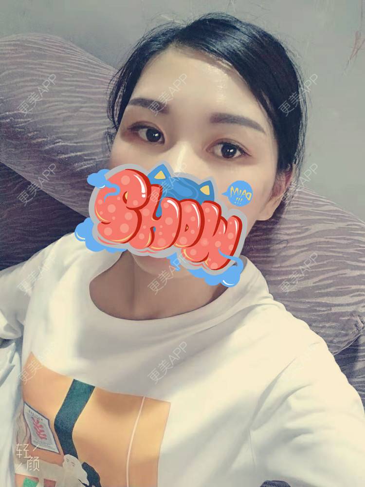更美 - 杨丽 医生的双眼皮经验 | 双眼皮