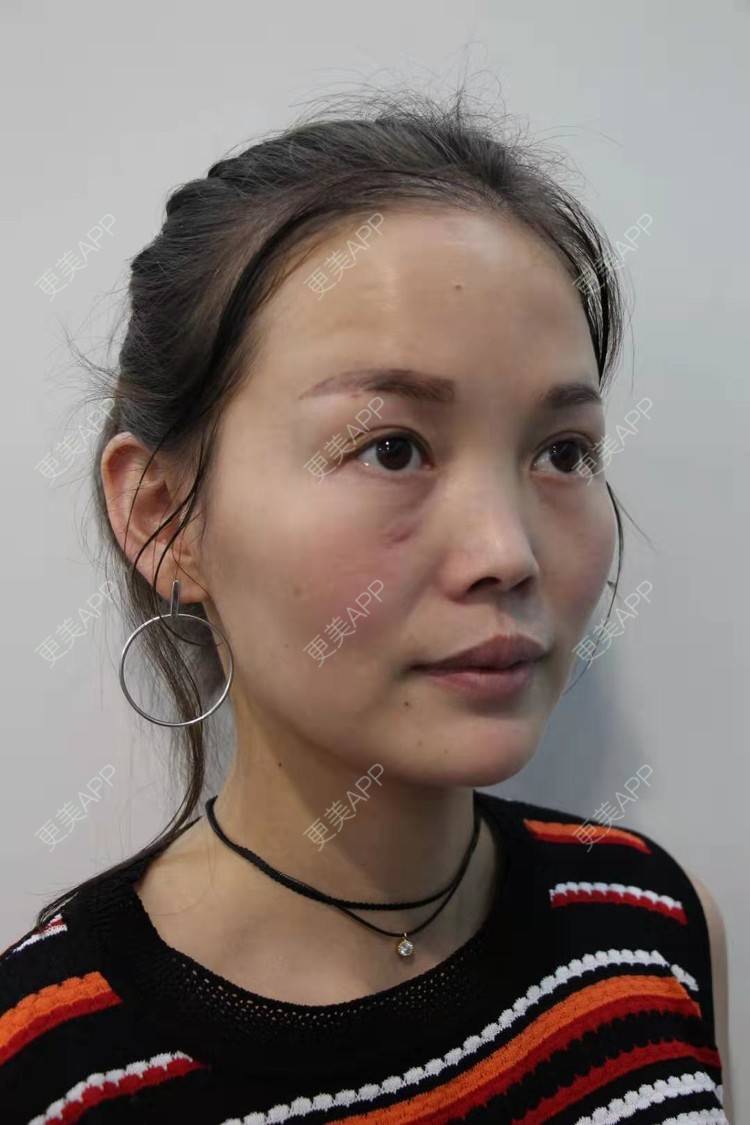 雪山上的一屡光的自体脂肪填充泪沟日记