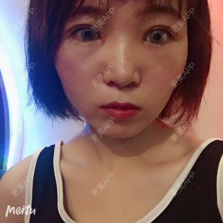 更美 - 更美用户6d6gGsAMox的双眼皮经验 | 双眼皮 | 石家庄