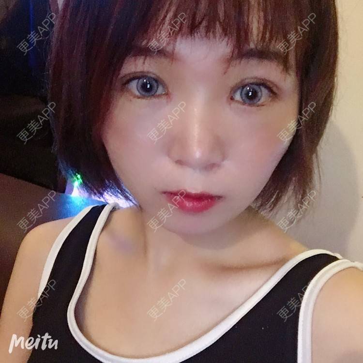 更美 - 更美用户6d6gGsAMox的双眼皮经验 | 双眼皮 | 石家庄