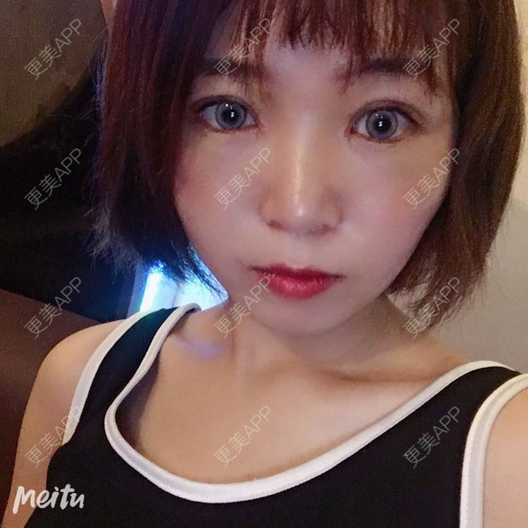 更美 - 更美用户6d6gGsAMox的双眼皮经验 | 双眼皮 | 石家庄