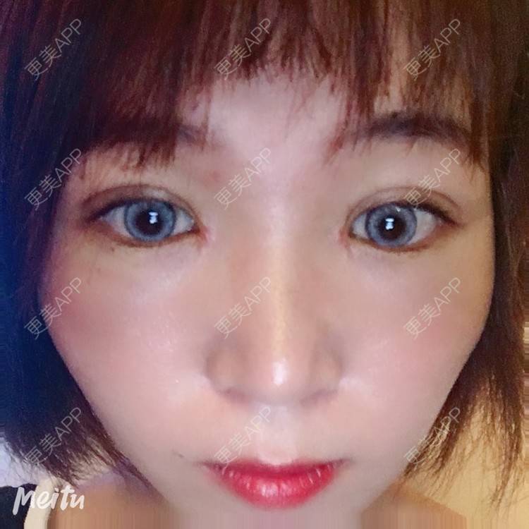 更美 - 更美用户6d6gGsAMox的双眼皮经验 | 双眼皮 | 石家庄