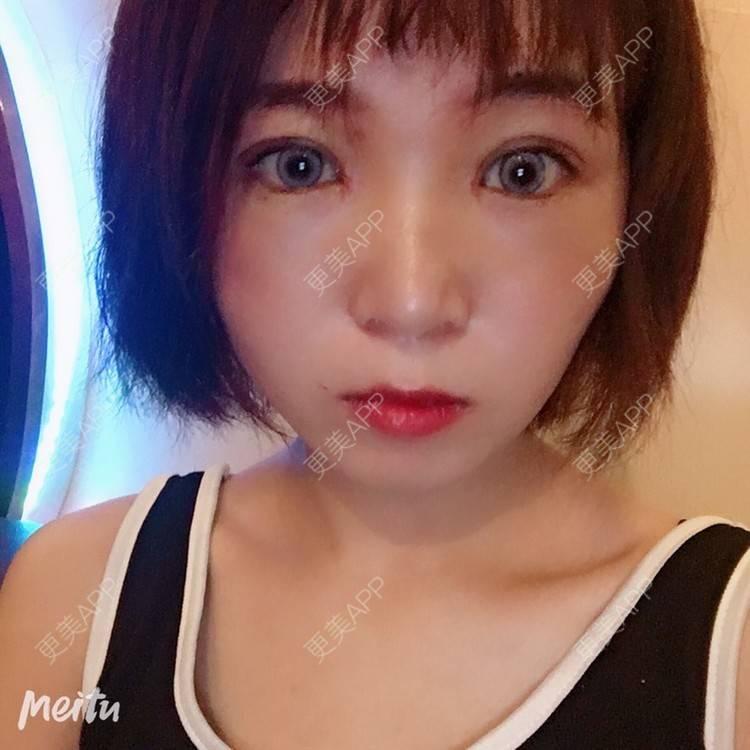 更美 - 更美用户6d6gGsAMox的双眼皮经验 | 双眼皮 | 石家庄