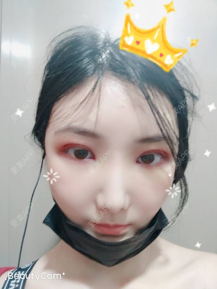 更美 - 更美用户EBRrEIgptp的颧骨颧弓经验 | 颧骨颧弓 | 郑州