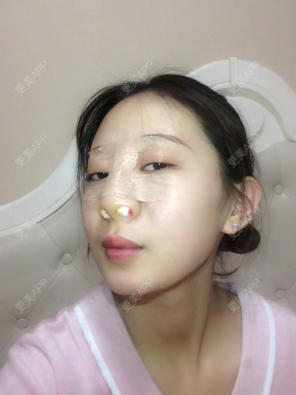 更美 - 更美用户jbmxBuS5BQ的鼻部多项经验 | 肋软骨隆鼻 | 鼻翼缩小 | 鼻部多项 | 鼻小柱缩短