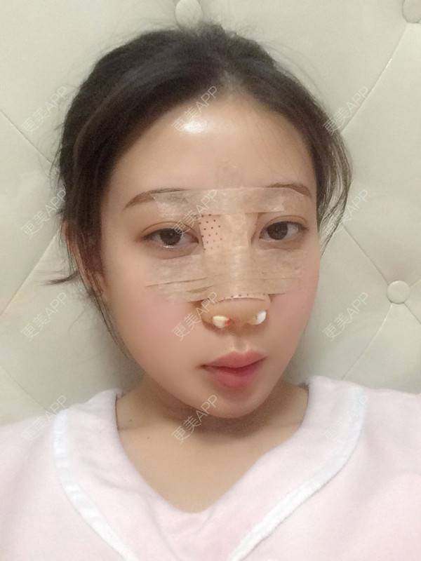 更美 - 更美用户jbmxBuS5BQ的鼻部多项经验 | 肋软骨隆鼻 | 鼻翼缩小 | 鼻部多项 | 鼻小柱缩短