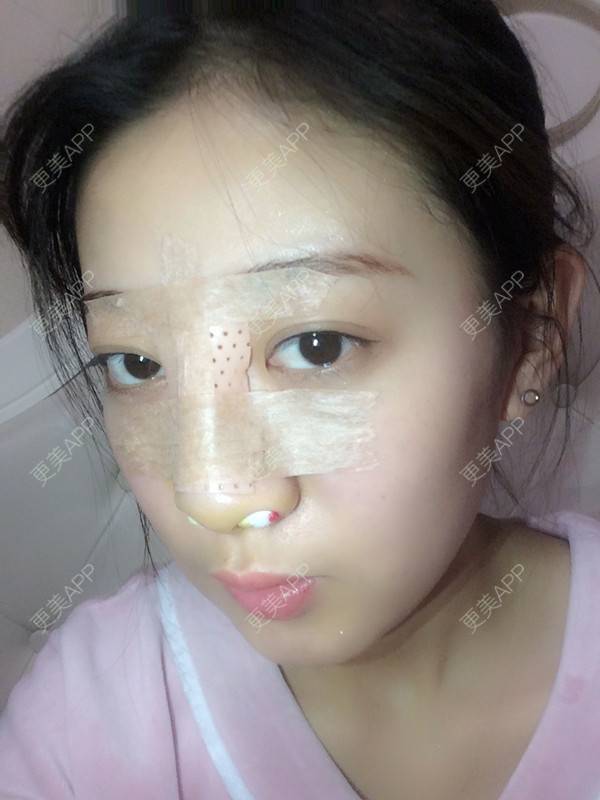 更美 - 更美用户jbmxBuS5BQ的鼻部多项经验 | 肋软骨隆鼻 | 鼻翼缩小 | 鼻部多项 | 鼻小柱缩短