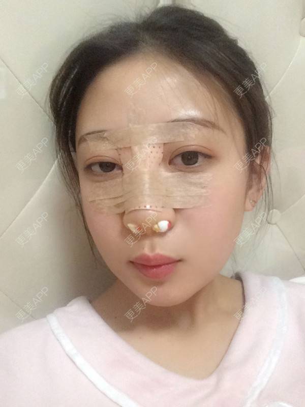 更美 - 更美用户jbmxBuS5BQ的鼻部多项经验 | 肋软骨隆鼻 | 鼻翼缩小 | 鼻部多项 | 鼻小柱缩短