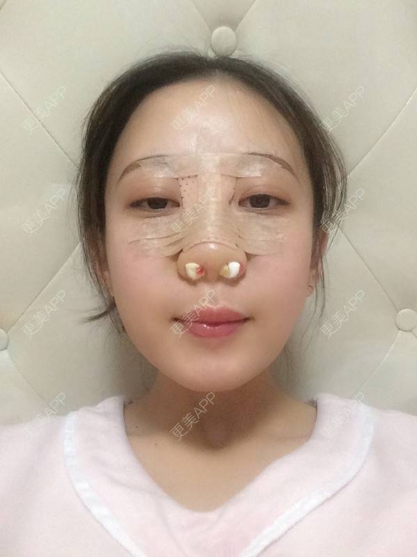 更美 - 更美用户jbmxBuS5BQ的鼻部多项经验 | 肋软骨隆鼻 | 鼻翼缩小 | 鼻部多项 | 鼻小柱缩短