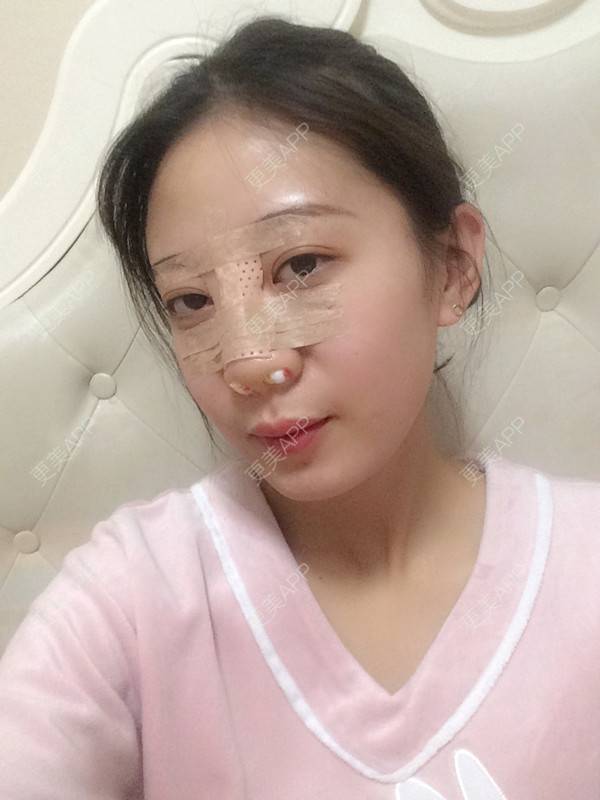 更美 - 更美用户jbmxBuS5BQ的鼻部多项经验 | 肋软骨隆鼻 | 鼻翼缩小 | 鼻部多项 | 鼻小柱缩短