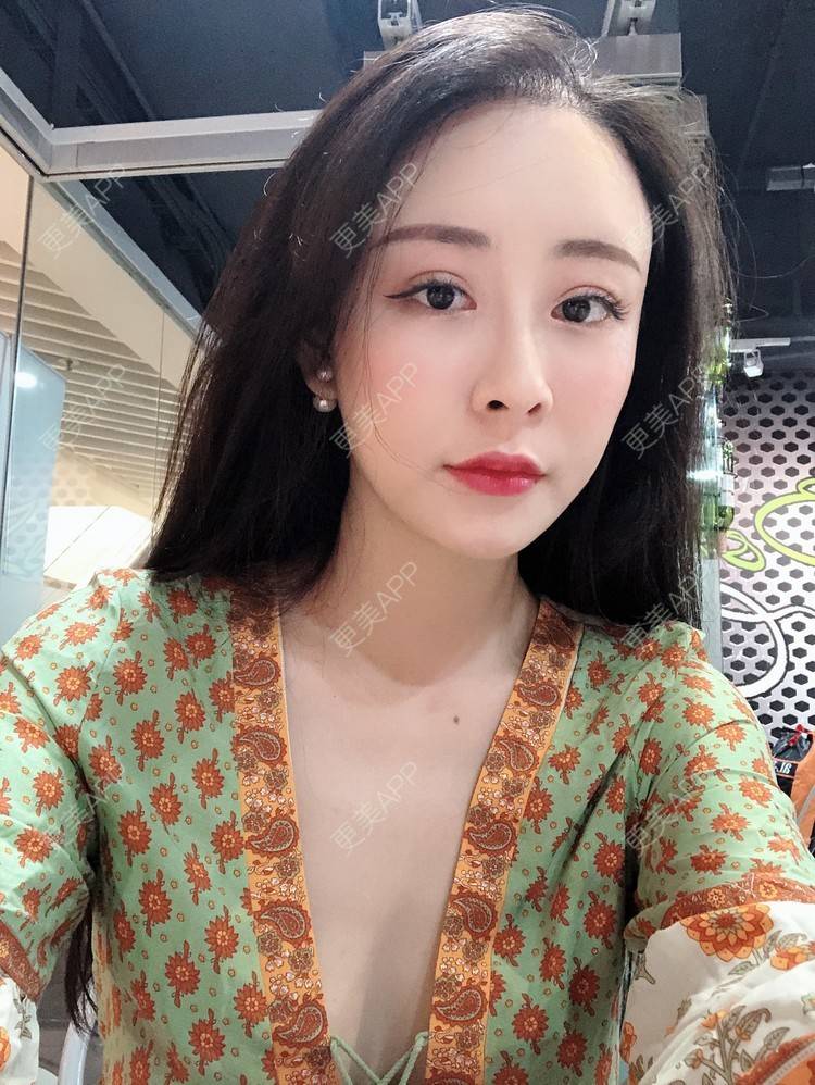 更美 - 兰质慧心的自体脂肪丰苹果肌经验 | 上海 | 视频日记 | 自体脂肪丰面颊 | 自体脂肪丰苹果肌 | 自体脂肪垫下巴