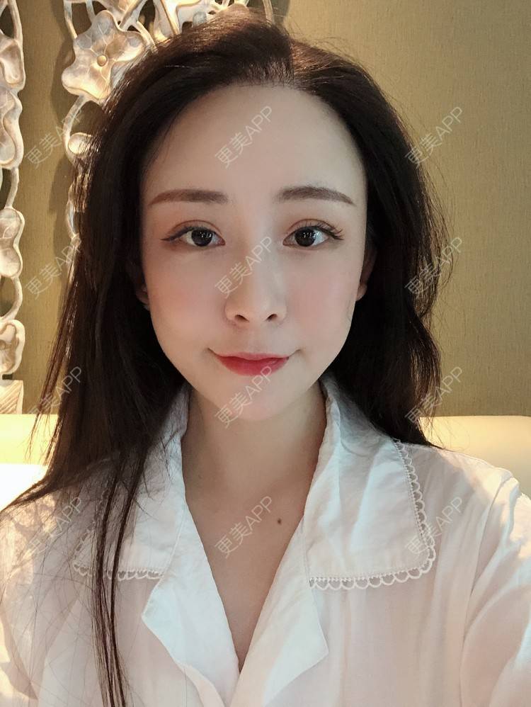 更美 - 兰质慧心的自体脂肪丰苹果肌经验 | 上海 | 视频日记 | 自体脂肪丰面颊 | 自体脂肪丰苹果肌 | 自体脂肪垫下巴