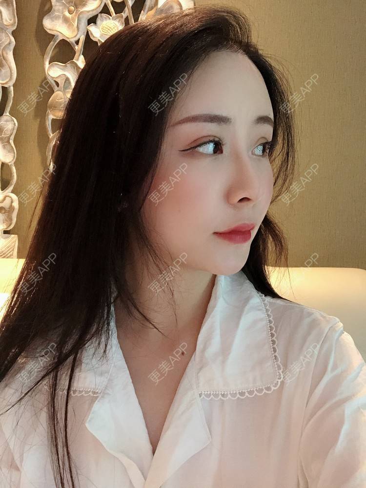 更美 - 兰质慧心的自体脂肪丰苹果肌经验 | 上海 | 视频日记 | 自体脂肪丰面颊 | 自体脂肪丰苹果肌 | 自体脂肪垫下巴