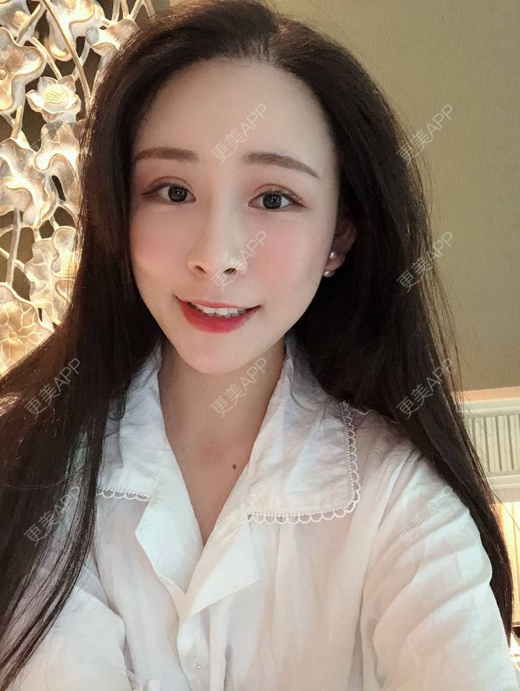 更美 - 兰质慧心的自体脂肪丰苹果肌经验 | 上海 | 视频日记 | 自体脂肪丰面颊 | 自体脂肪丰苹果肌 | 自体脂肪垫下巴