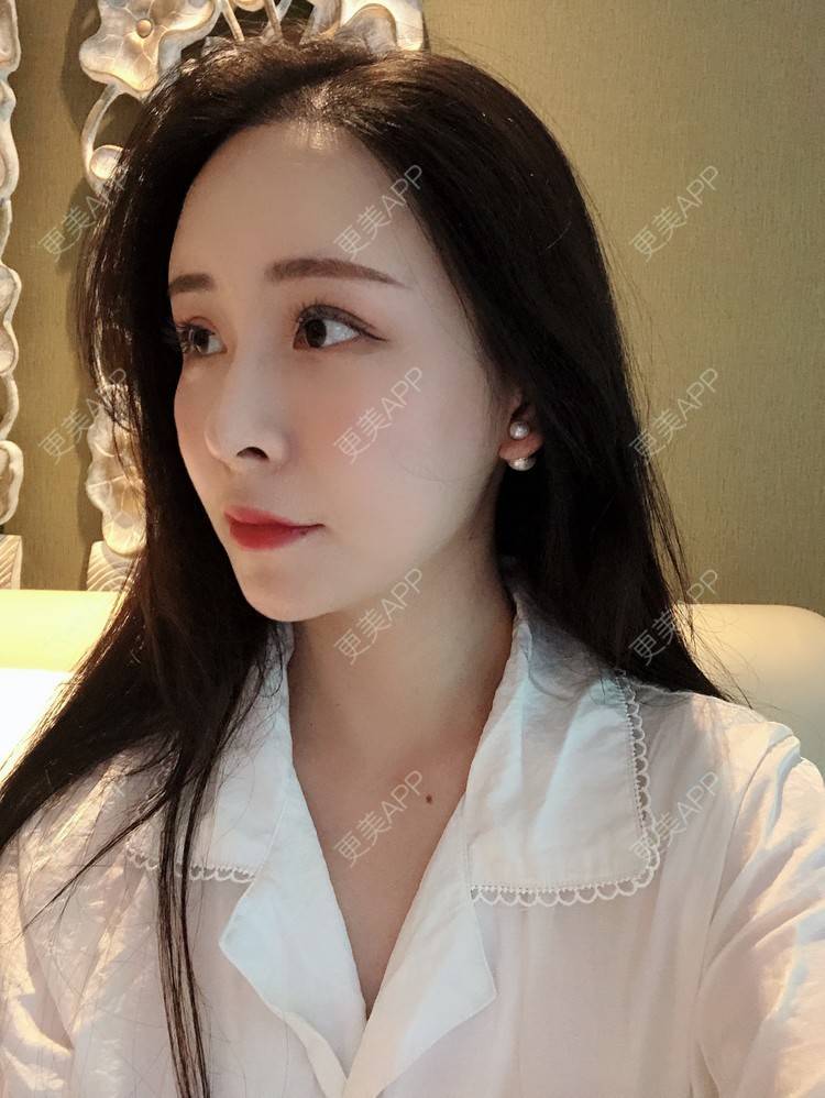 更美 - 兰质慧心的自体脂肪丰苹果肌经验 | 上海 | 视频日记 | 自体脂肪丰面颊 | 自体脂肪丰苹果肌 | 自体脂肪垫下巴