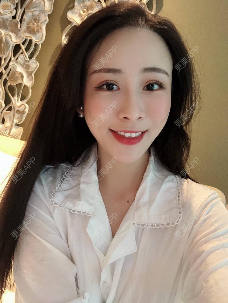 更美 - 兰质慧心的自体脂肪丰苹果肌经验 | 上海 | 视频日记 | 自体脂肪丰面颊 | 自体脂肪丰苹果肌 | 自体脂肪垫下巴