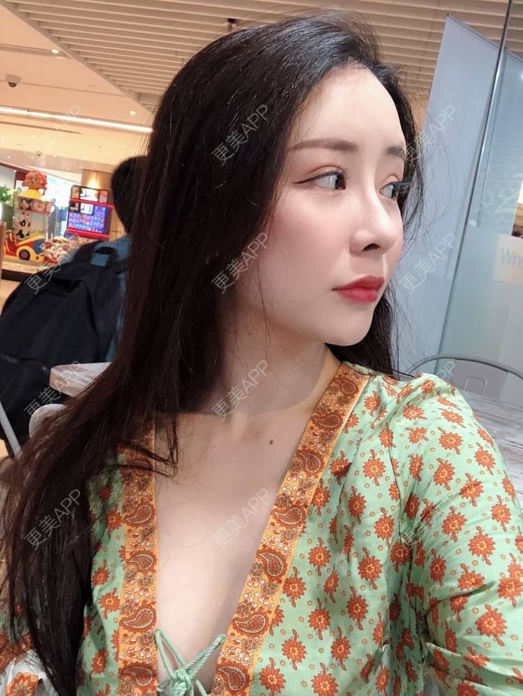更美 - 兰质慧心的自体脂肪丰苹果肌经验 | 上海 | 视频日记 | 自体脂肪丰面颊 | 自体脂肪丰苹果肌 | 自体脂肪垫下巴