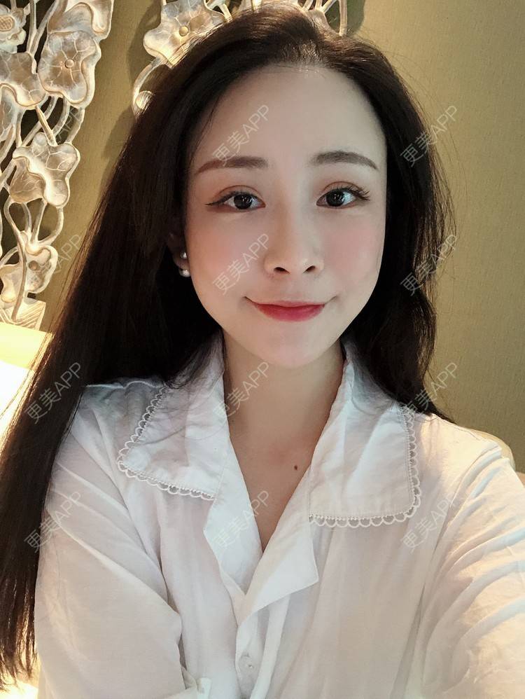 更美 - 兰质慧心的自体脂肪丰苹果肌经验 | 上海 | 视频日记 | 自体脂肪丰面颊 | 自体脂肪丰苹果肌 | 自体脂肪垫下巴