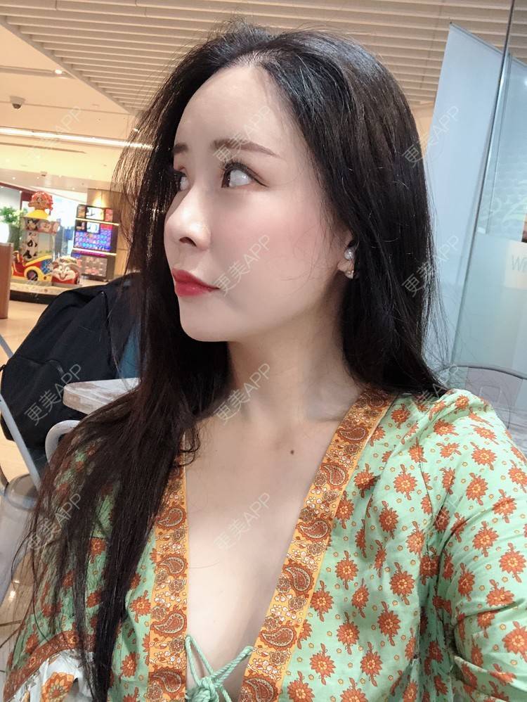 更美 - 兰质慧心的自体脂肪丰苹果肌经验 | 上海 | 视频日记 | 自体脂肪丰面颊 | 自体脂肪丰苹果肌 | 自体脂肪垫下巴