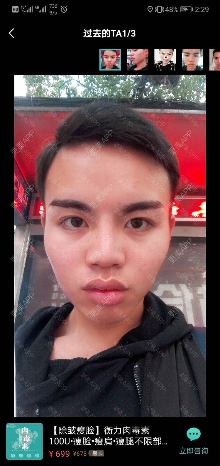 更美 - 更美用户吕祥的面部脱毛经验 | 面部脱毛 | 苏州 | 美购日记