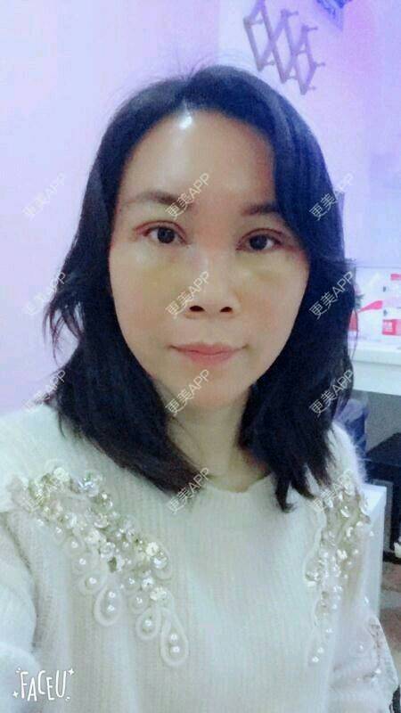 更美 - 更美用户SH2u1KRUkN的眶隔脂肪释放经验 | 眶隔脂肪释放 | 西安