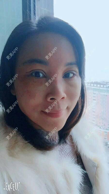 更美 - 更美用户SH2u1KRUkN的眶隔脂肪释放经验 | 眶隔脂肪释放 | 西安