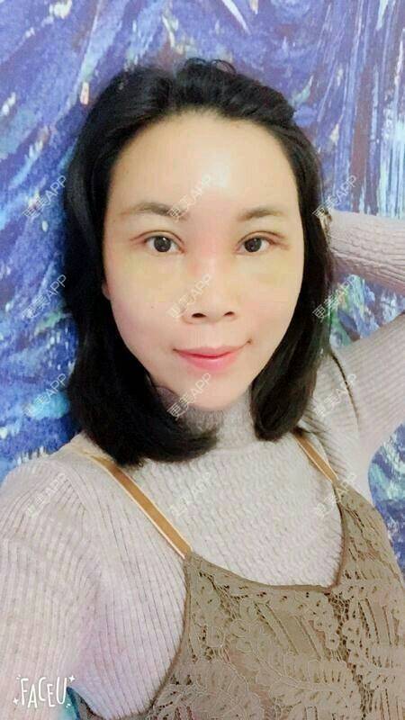 更美 - 更美用户SH2u1KRUkN的眶隔脂肪释放经验 | 眶隔脂肪释放 | 西安