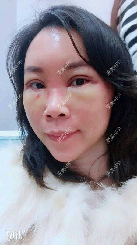 更美 - 更美用户SH2u1KRUkN的眶隔脂肪释放经验 | 眶隔脂肪释放 | 西安