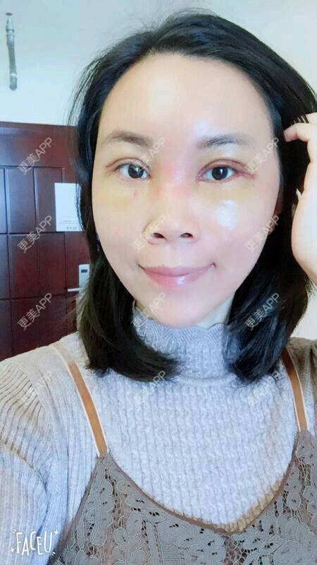 更美 - 更美用户SH2u1KRUkN的眶隔脂肪释放经验 | 眶隔脂肪释放 | 西安