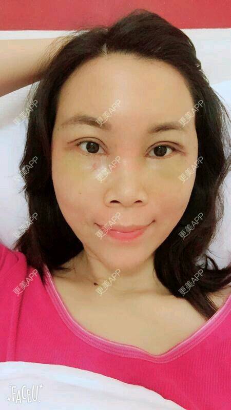 更美 - 更美用户SH2u1KRUkN的眶隔脂肪释放经验 | 眶隔脂肪释放 | 西安