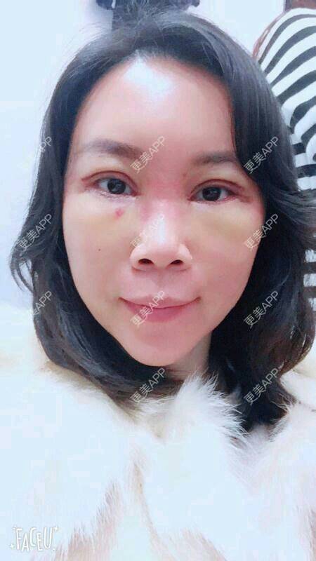 更美 - 更美用户SH2u1KRUkN的眶隔脂肪释放经验 | 眶隔脂肪释放 | 西安