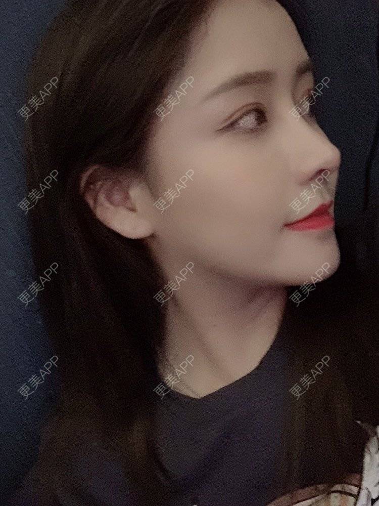 更美 - 端庄而又沉稳的我的鼻部多项经验 | 鼻部多项 | 鼻中隔软骨垫鼻头 | 自体软骨垫鼻尖 | 鼻小柱缩短 | 手术缩鼻头 | 膨体隆鼻 | 肋软骨隆鼻 | 鼻小柱延长 | 鼻部综合