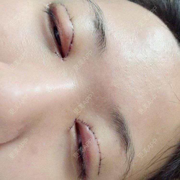 更美 - 艺锦的双眼皮经验 | 双眼皮 | 成都