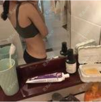 更美 - 更美用户KpoO2wpZCv的微针淡化妊娠纹经验 | 上海 | 微针淡化妊娠纹