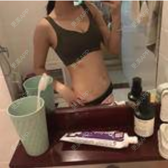 更美 - 更美用户KpoO2wpZCv的微针淡化妊娠纹经验 | 上海 | 微针淡化妊娠纹