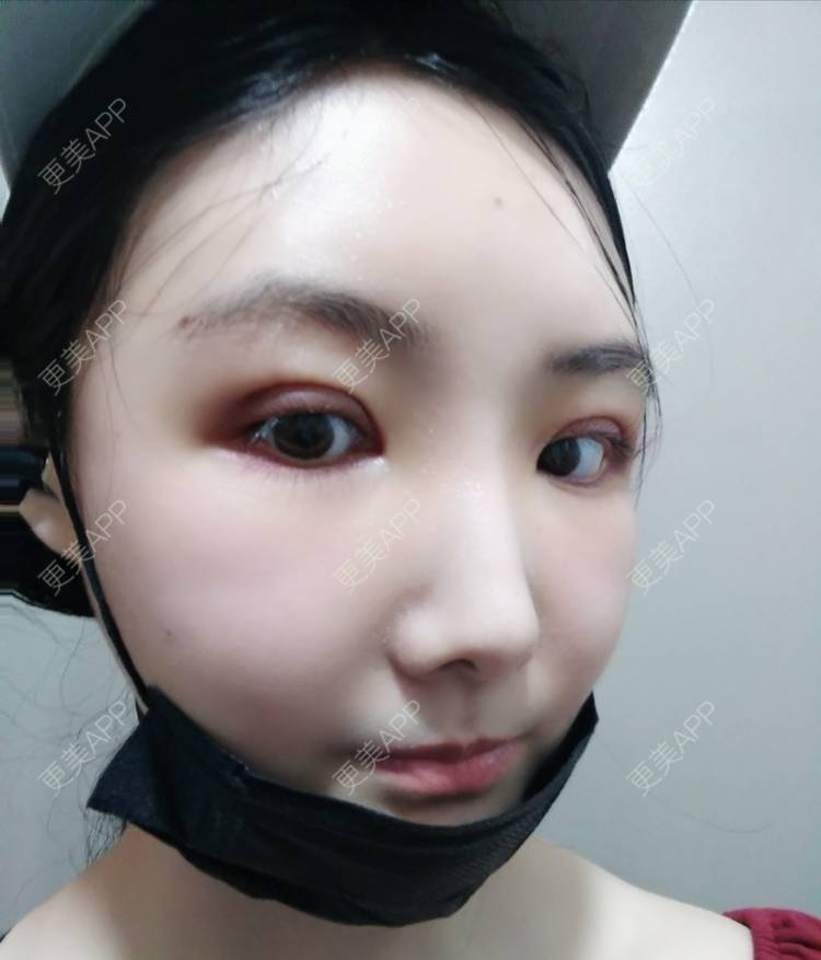 更美 - 更美用户EBRrEIgptp的颧骨颧弓经验 | 颧骨颧弓 | 郑州