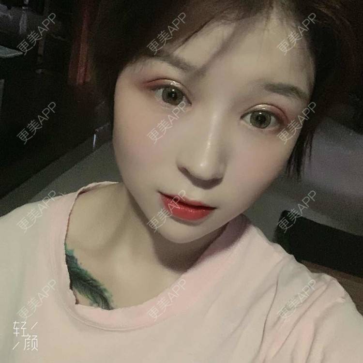 更美 - 徐金玉 医生的全切双眼皮经验 | 开眼角 | 全切双眼皮
