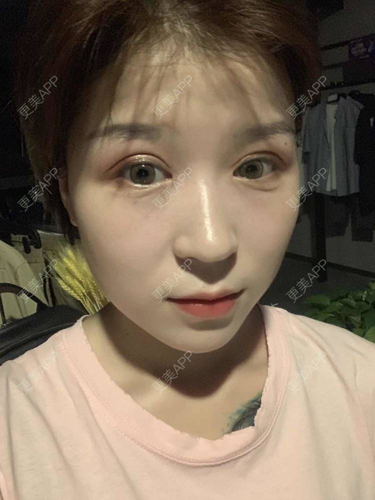 更美 - 徐金玉 医生的全切双眼皮经验 | 开眼角 | 全切双眼皮