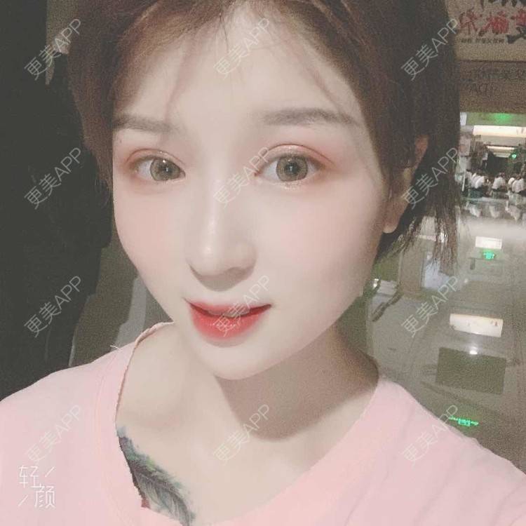 更美 - 徐金玉 医生的全切双眼皮经验 | 开眼角 | 全切双眼皮