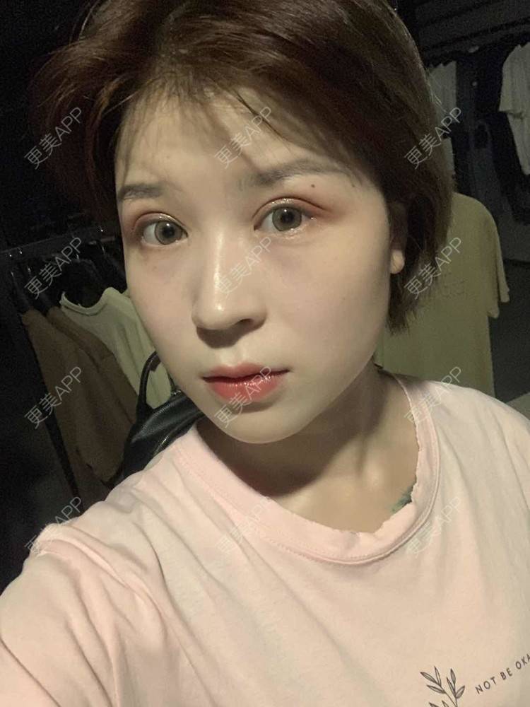 更美 - 徐金玉 医生的全切双眼皮经验 | 开眼角 | 全切双眼皮